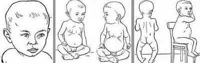 Признаки рахита у грудных детей
